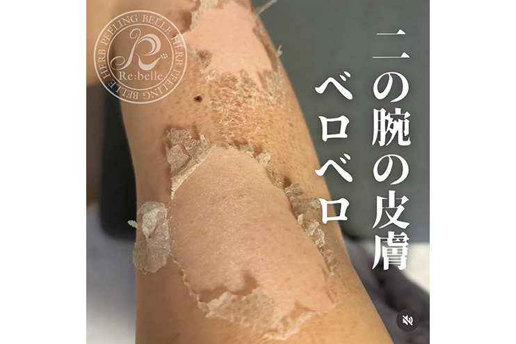ハーブピーリング